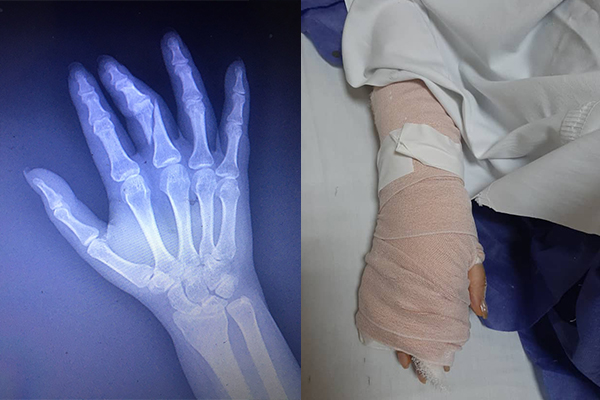انگشتان دست «فائزه مومنی»، روزنامه‌نگار، توسط مامور حراست دانشگاه علوم پزشکی شکسته شد