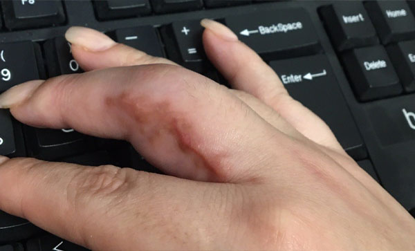 ۶ هفته پس از ضرب‌و‌شتم توسط مامور حراست: چیکار کردید با انگشت من؟